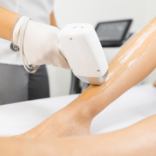 Diode Lazer Epilasyon